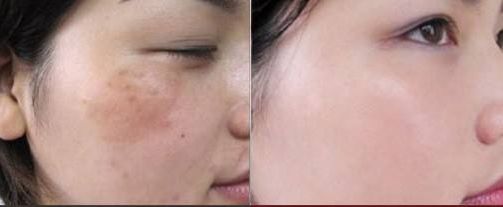 深圳陳星光醫(yī)生分享如何進行胸部豐滿整形