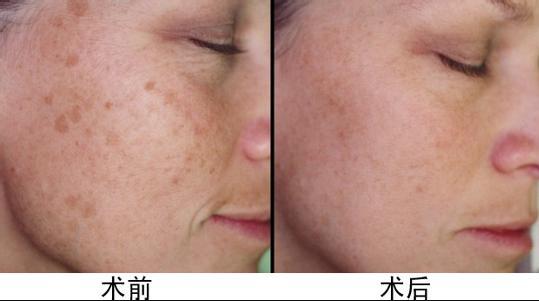 合肥有哪些醫(yī)院是治療祛斑效果明顯的？