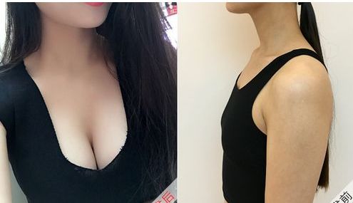 安醫(yī)大一附院整形外科推薦醫(yī)生，自體脂肪隆胸效果好