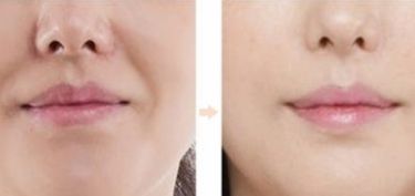 南京華韓奇致醫(yī)生解答：如何進(jìn)行眼睛手術(shù)？2023真實(shí)案例發(fā)布