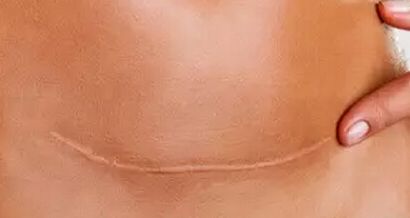 滄州京美醫(yī)療美容醫(yī)院分享全新吸脂成功案例