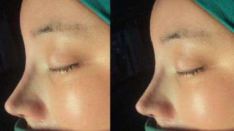 最佳2023西安雙眼皮修復(fù)醫(yī)生推薦！宋保強(qiáng)、馬顯杰好評如潮，立即預(yù)約！