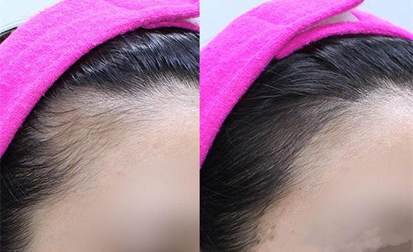 鄭州哪家醫(yī)院擅長祛斑，技術(shù)精湛值得推薦！