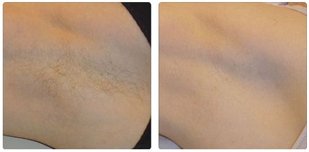 顧云鵬吸脂效果如何？是否值得嘗試？