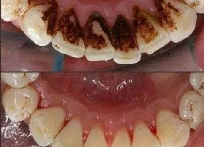 上海蝶可變整形醫(yī)院豐胸案例新鮮發(fā)布，引領(lǐng)時(shí)尚潮流