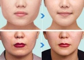 杭州哪家醫(yī)院做下頜角整形效果好？綜合口碑、價格受好評的幾家醫(yī)院推薦