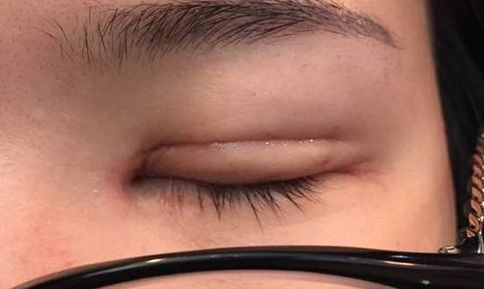 揭秘車紅昌教授的雙眼皮手術(shù)及成功案例分享