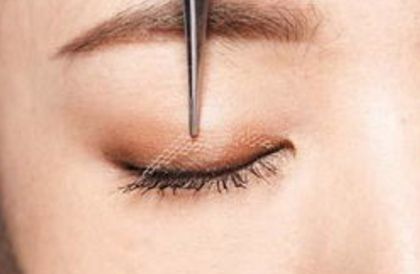 鄭州賈亮眼部整形技術(shù)介紹，修復(fù)雙眼皮效果如何？成功案例披露