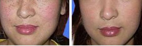 龍崗中心醫(yī)院整形科的雙眼皮修復(fù)醫(yī)生怎么樣？