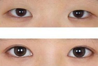 揚(yáng)州陳嘯醫(yī)生的雙眼皮手術(shù)功力與成功案例分享