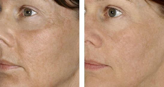 北京下頜角修復(fù)專家推薦，張笑天助您實現(xiàn)理想瘦臉！