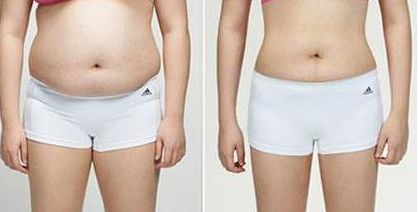 耳垂豐耳還是要慎重！使用玻尿酸的危害大不可忽視！聽悅耳的聲音之前，先了解這個！