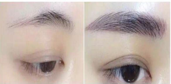 專家為您解答：涿州市哪家醫(yī)院可進行瘦臉針治療？費用如何？醫(yī)師推薦為參考