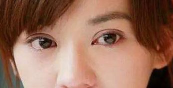 探索成都圣丹福整形醫(yī)院的雙眼皮修復(fù)成果，經(jīng)驗分享