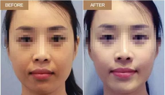 廣州哪家醫(yī)院鼻修復(fù)效果突出？這些醫(yī)院實(shí)力不可小覷！