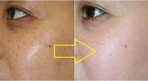 杭州哪家醫(yī)院是比較好的隆鼻選擇？