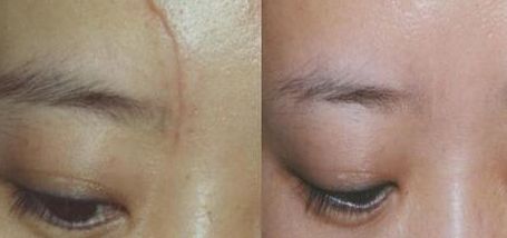 杭州一位醫(yī)生的雙眼皮手術(shù)實踐分享，持續(xù)80天的親身經(jīng)歷！