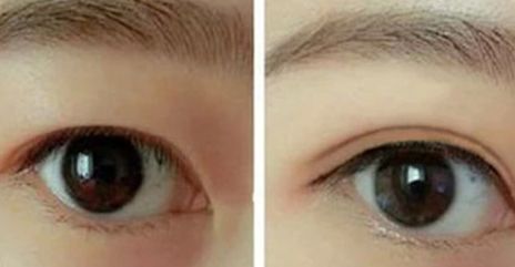 葉飛輪醫(yī)生：雙眼皮手術(shù)技術(shù)解析，真人案例揭秘！