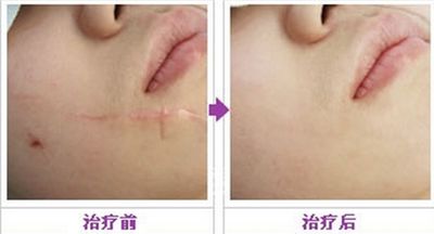 廣州做吸脂手術(shù)哪家醫(yī)院效果好？這幾家技術(shù)領(lǐng)先