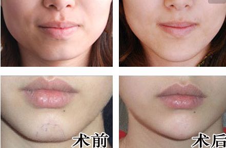 廣州人中縮短手術醫(yī)生推薦？網友真實評價與信息公開！