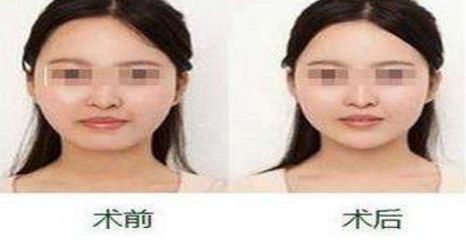 揚(yáng)州隆胸專(zhuān)家2024榜單評(píng)選揭曉：挑選胸部整形領(lǐng)域翹楚！