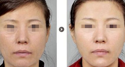 烏魯木齊哪里可以做雙眼皮手術(shù)？選擇哪家醫(yī)院效果好？