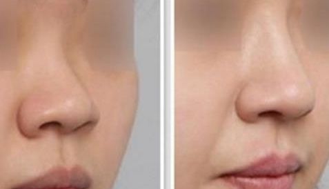 南京上官文松下頜角手術(shù)經(jīng)驗(yàn)分享及手術(shù)多樣性探討