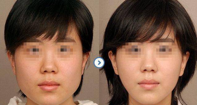 成都隆鼻醫(yī)生排行榜2024：專家推薦的醫(yī)院大揭秘！