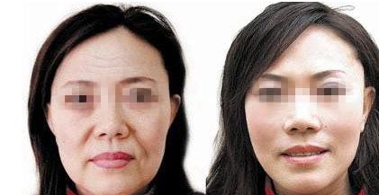 成都自然雙眼皮去哪家醫(yī)院靠譜？