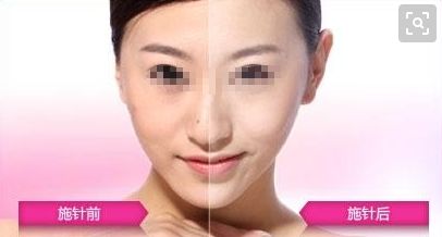 廣州哪家醫(yī)院可以安全進(jìn)行拉皮手術(shù)？