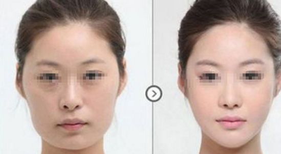 長(zhǎng)春鼻整形哪所醫(yī)院靠譜