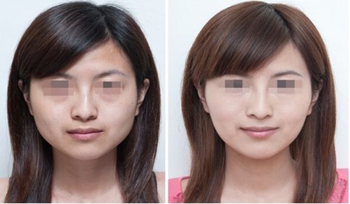 無錫專業(yè)鼻綜合整形醫(yī)院推薦