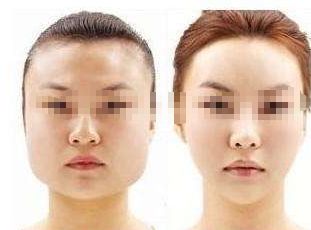 告別痘痘困擾，打造光彩肌膚