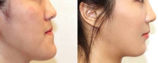 南京施爾美醫(yī)院醫(yī)生案例對(duì)比，讓你信服！