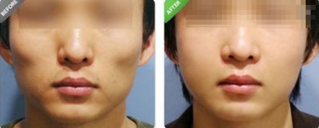 深圳哪家醫(yī)院的拉皮除皺效果最好？排名前幾位的醫(yī)院有哪些？