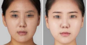 上海八院脂肪填充手術(shù)費(fèi)如何？專家拆解詳情及特色優(yōu)勢