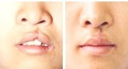 南昌割雙眼皮口碑醫(yī)院大盤點！這3家備受推崇