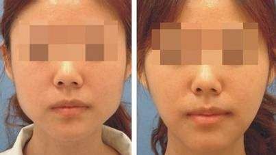上海哪家醫(yī)院的下巴隆鼻手術(shù)效果最好？