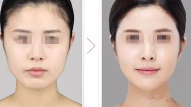 長沙雙眼皮整形醫(yī)院推薦，哪家效果更好？