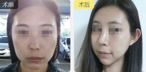 合肥雙眼皮整形推薦：口碑好、技術(shù)精湛、性價比高的醫(yī)生