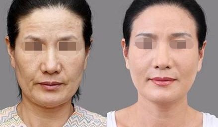 徐州哪家醫(yī)院割雙眼皮效果好？前四名醫(yī)院盤點