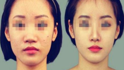 沈陽哪家醫(yī)院做面部大拉皮除皺效果好？排行榜前十推薦