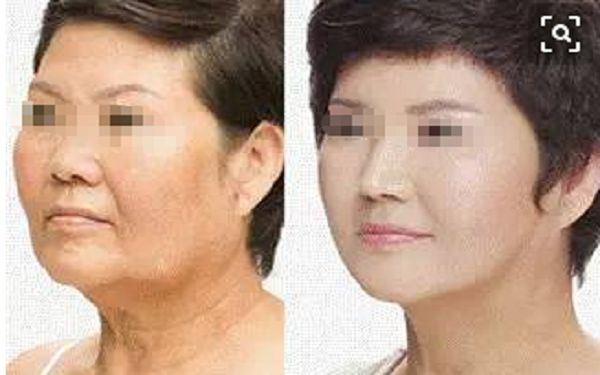 西安哪家醫(yī)院可信賴進(jìn)行隆鼻手術(shù)