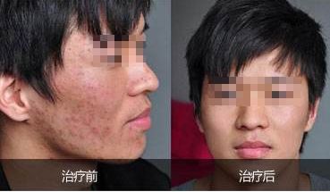 重慶吸脂哪家好？華美吸脂專家經(jīng)驗豐富，安全保障