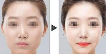 成都整形美容醫(yī)院脂肪填充哪家好