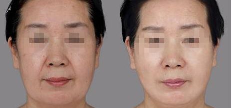 樂山哪家整形醫(yī)院雙眼皮比較好？匯總單六強(qiáng)預(yù)測(cè)