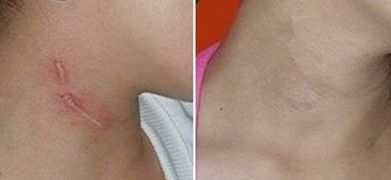 探索蘇州衛(wèi)康植發(fā)的口碑、手術(shù)效果及價格公開