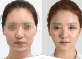 南寧市哪家醫(yī)院做雙眼皮好？