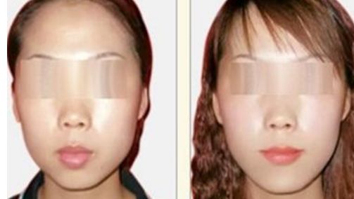 荊州哪個醫(yī)院能做隆鼻手術(shù)效果好？