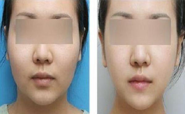 上海盧九寧醫(yī)生小腿塑形案例：顯微技術(shù)打造纖細(xì)美腿